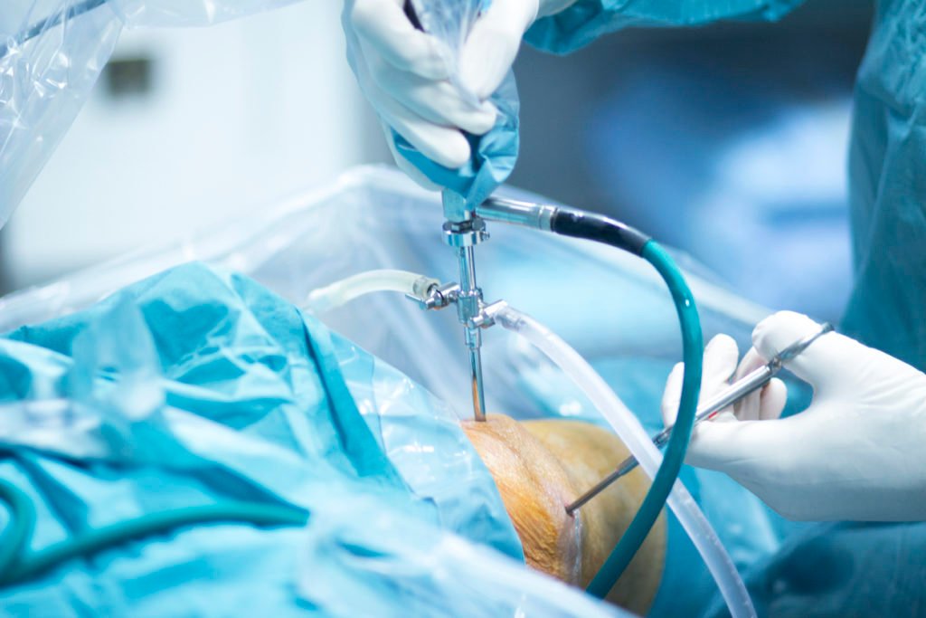 Pre-Arthroscopy procedure