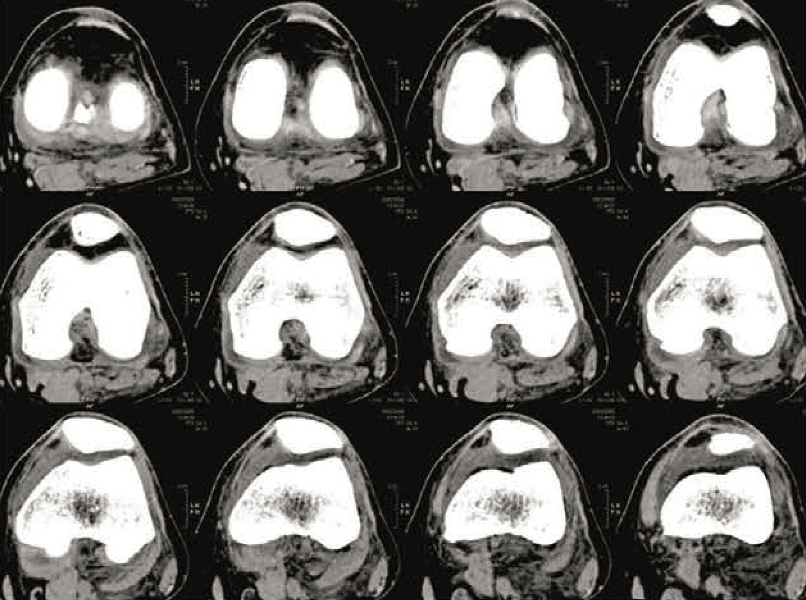 After robotic surgery