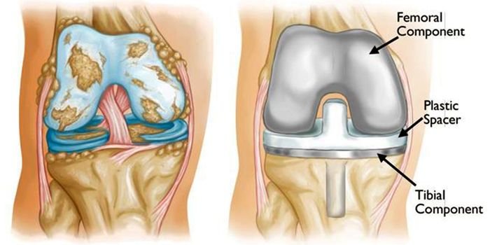 Total Knee Replacement